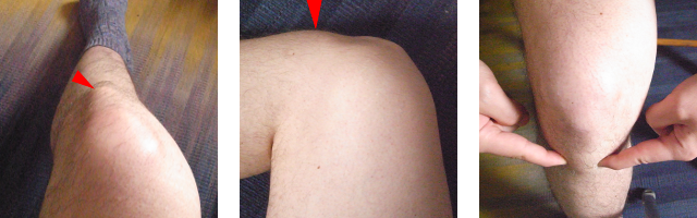 tibial tubercle palpation