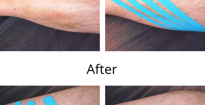 K-taping before after